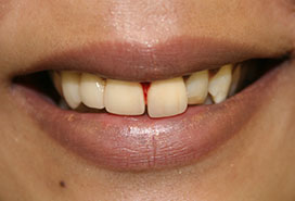 Before